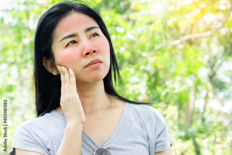5 Tips for Handling Eczema During the Summer | Expert Advice 4 Asian woman having face skin problem with sunburn redness from ultraviolet of sunlight standing outdoors under sunny day