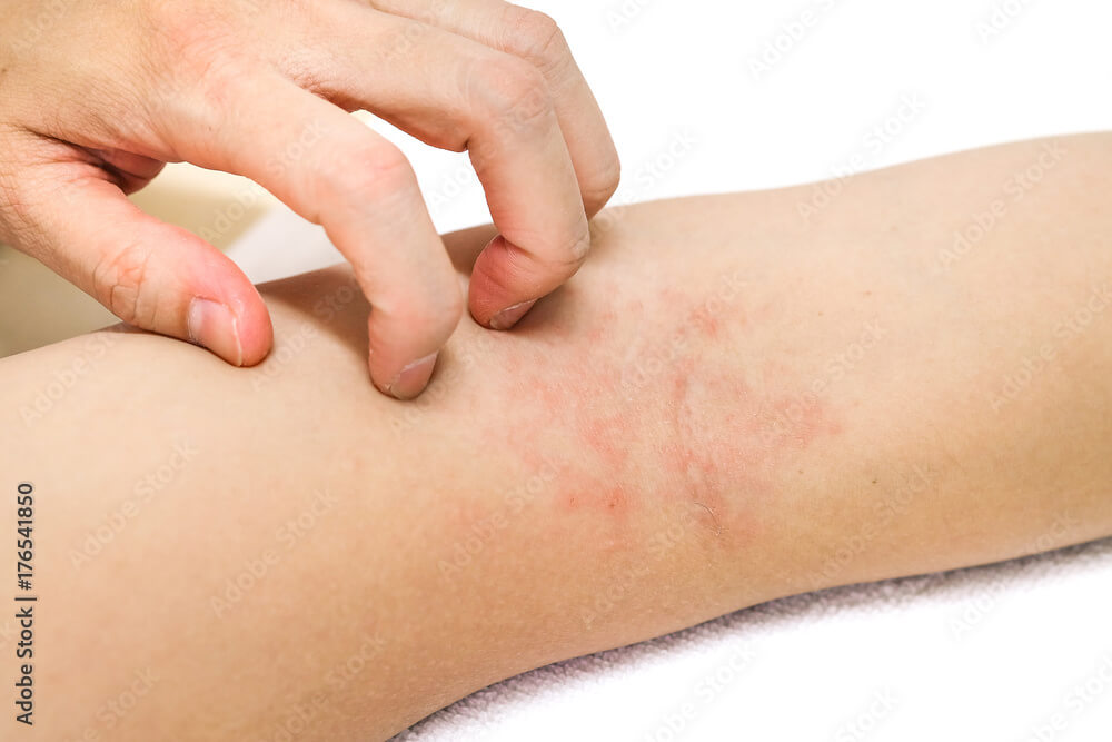 Women's hands are scratching allergy to red rash on white background