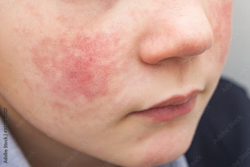 Boy with red cheeks- diathesis or allergy symptoms. Redness and peeling of the skin on the face.